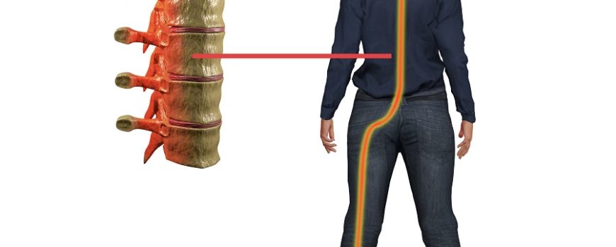 Are You Suffering from Sciatica Pain?